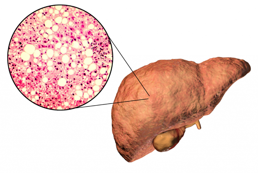 fígado com células de gordura
