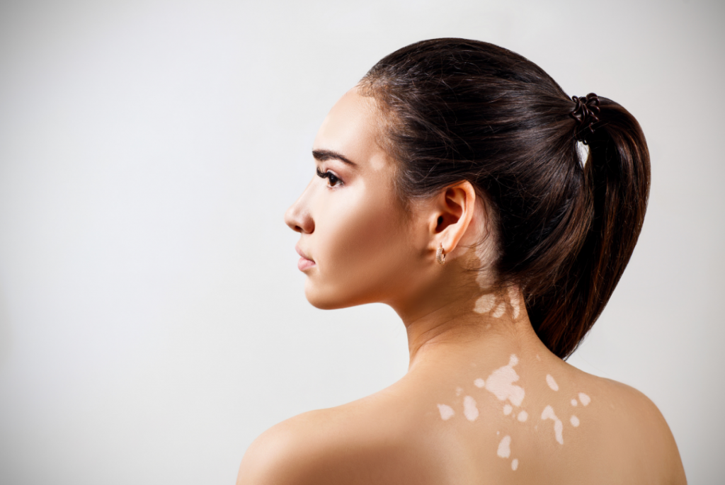 Mulher de costas com vitiligo