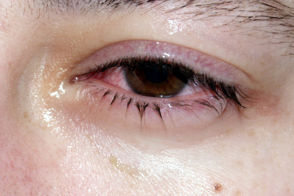 olho vermelho com conjuntivite