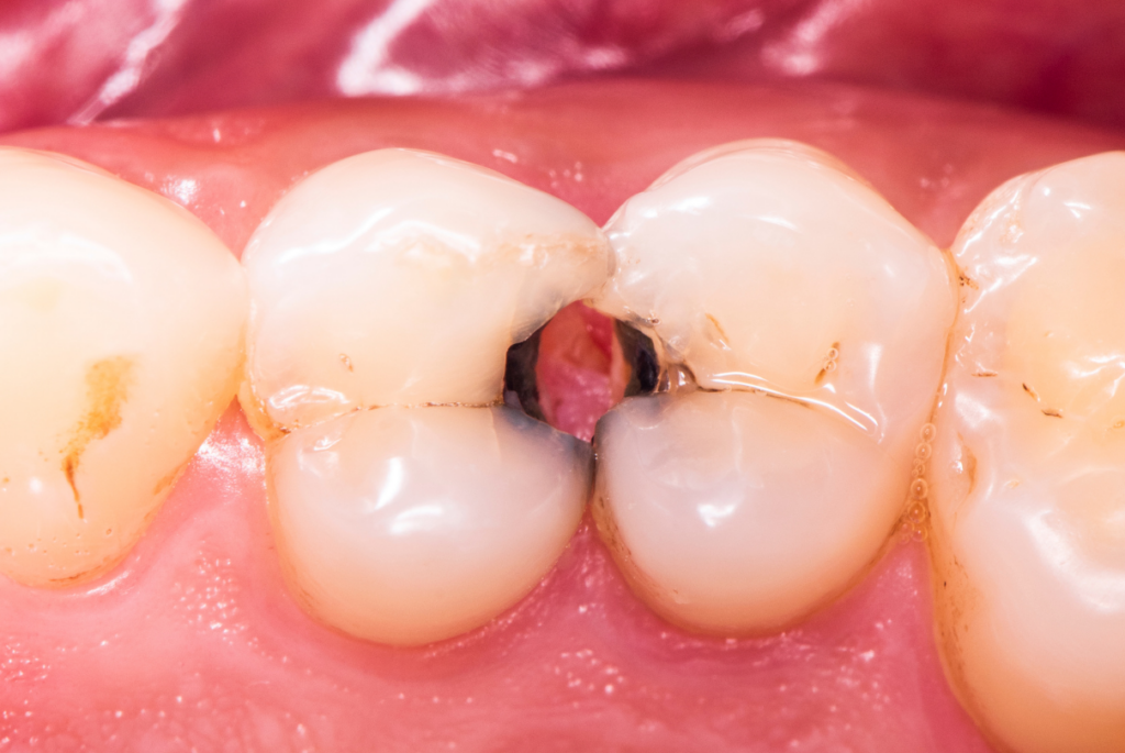 Dente com cárie