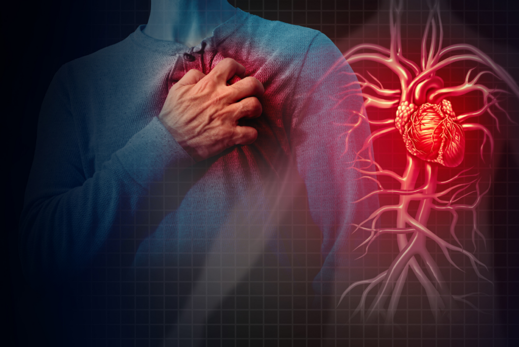 Esquema de infarto