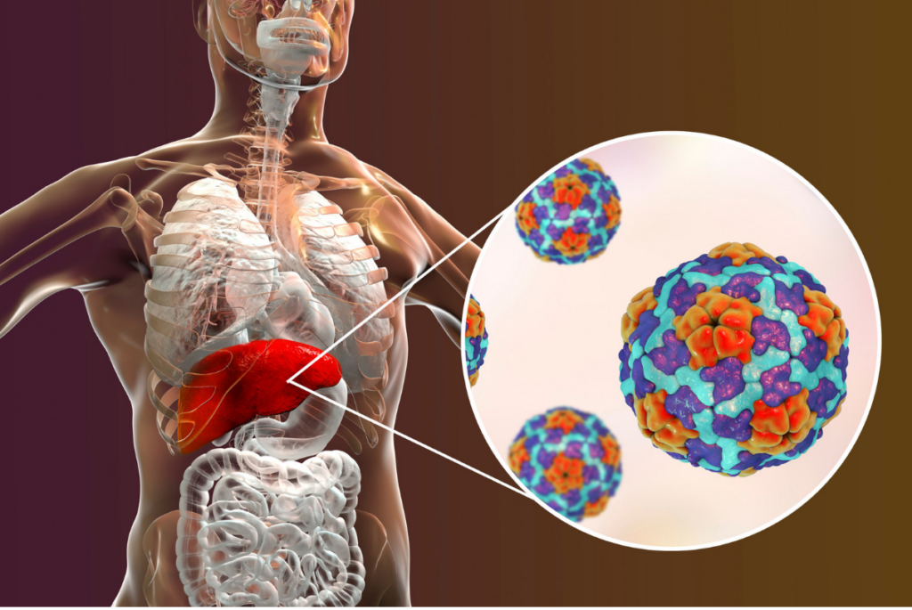 Esquema de fígado com hepatite